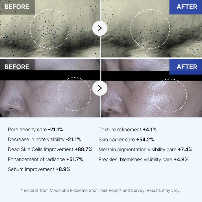 Ultimate Dark Spot Removal Duo: Exosome Micro-Needle + Vitamin C Serum