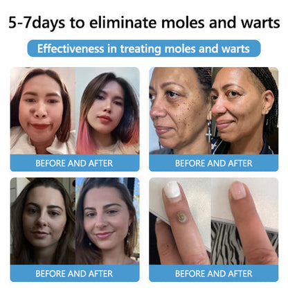 Acne Drying Lotion – Fights Inflamed & Pus-Filled Pimples Fast