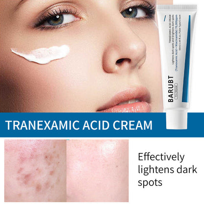 TX Tranexamic Acid CREAM | Skin freckle Cream, Blemishes, Anti-pigmetation